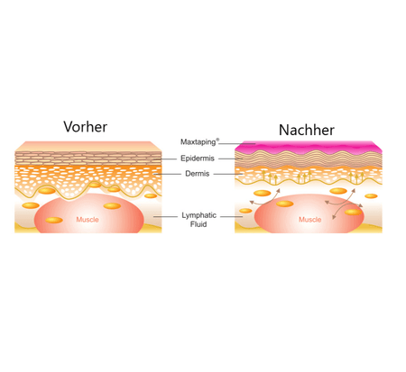Kinesiologisches Tape Großpackung Maxtaping A+ – Vorher-Nachher Grafik zur Hautanhebung, Lymphfluss & Muskelentlastung